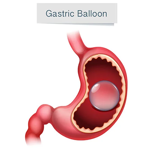 balaogastrico